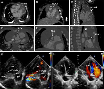 Case Report: Isolate Congenital Coronary Artery Fistula With Giant Artery Aneurysm in a Neonate